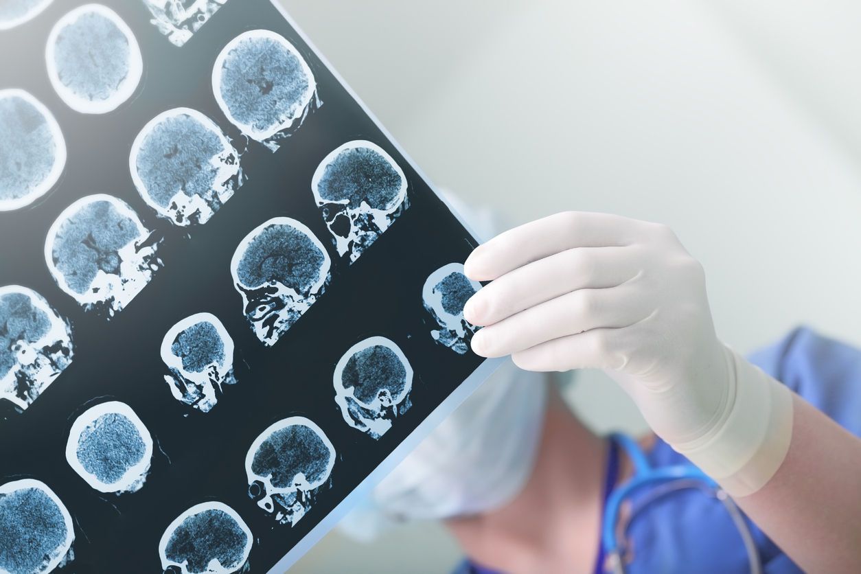 Precise Diagnostics Drive Treatment Plans for Alzheimer’s Disease