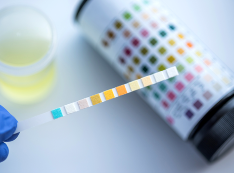 An image of urine test.