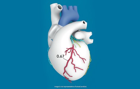 Heartflow