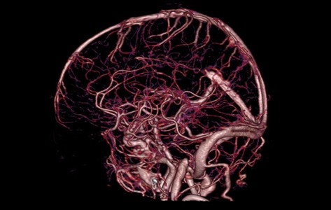 Brain angiography