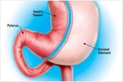 gastric sleeve