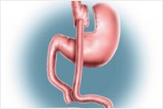 Diagram of Laparoscopic Roux-en-Y Gastric Bypass 