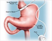 Diagram LAP-BAND® or REALIZE™ Band