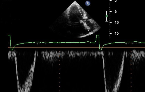 Echocardiographic Image