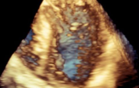 Echocardiographic Image