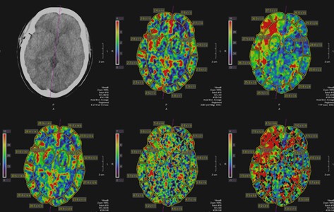 brain image with a CT scan