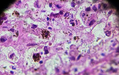 Melanoma